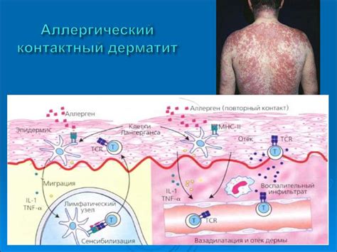 Аллергические реакции и кожные заболевания